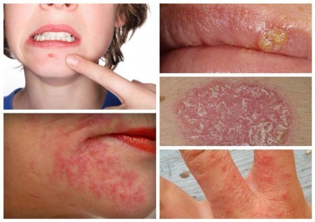 Алергія і скурныя захворванні - прыкметы паразітаў у арганізме